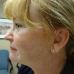 Face and Neck Lift