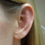 Otoplasty