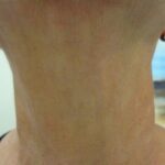 Botox