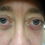 Blepharoplasty