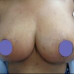 Mastopexy