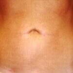 Liposuction