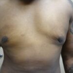 Gynecomastia