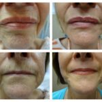 Perioral Dermabrasion