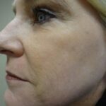 Chemical Peel Full Face