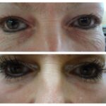 Chemical Peel Lower Eyes