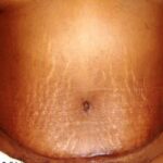Tummy-tuck