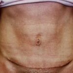 Mini Tummy Tuck