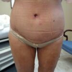 Circumferential Abdominoplasty and Thigh Lift