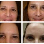 Brow Lift