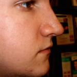 Rhinoplasty