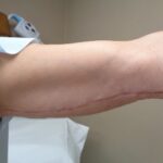 Brachioplasty