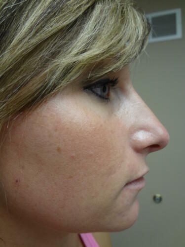 Rhinoplasty